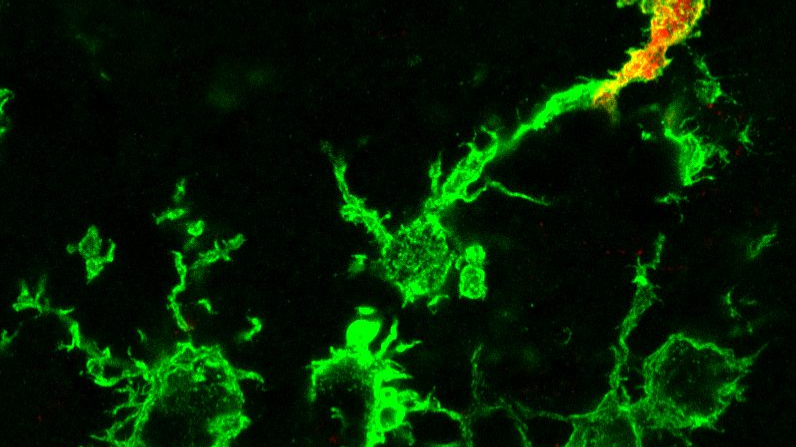 Schlaganfall: Makrophagen wandern aus dem Blut ein 