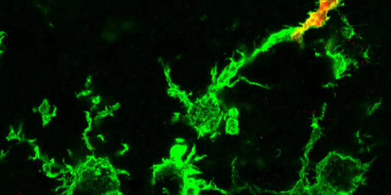 Schlaganfall: Makrophagen wandern aus dem Blut ein 