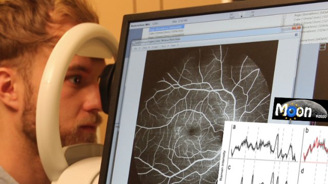 Alzheimer an den Augen erkennen