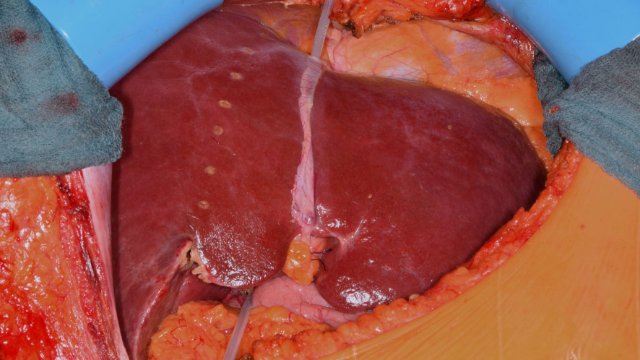 Behandlungsoption bei Lebermetastasen: Zweistufige Transplantation