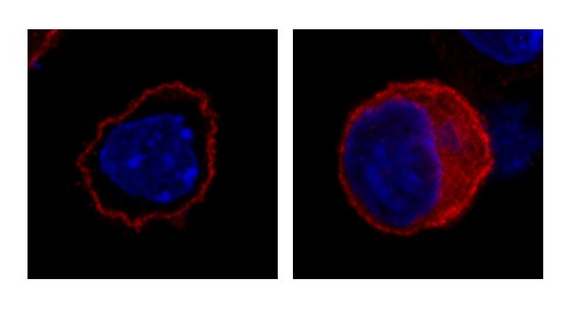Seltene Erkrankung erstmals am UKJ beschrieben