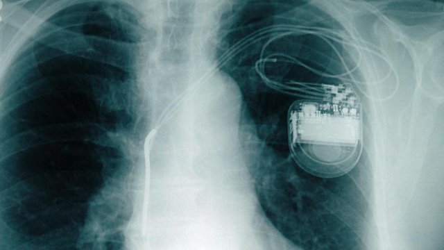 Brauchen Herzschrittmacher zu neueren iPhones mehr Abstand?