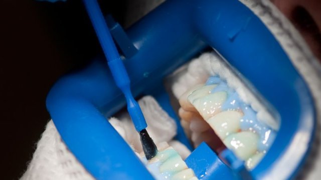 Bleaching-Produkte: Was macht die Zähne wieder weiß?