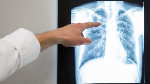 Mehr Tuberkulose-Fälle in Rheinland-Pfalz